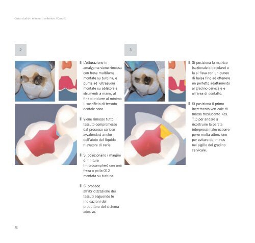 Ricostruzioni estetiche in composito - Heraeus