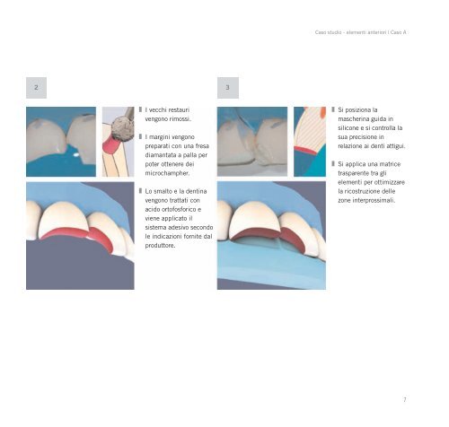 Ricostruzioni estetiche in composito - Heraeus