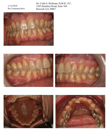 Recession, Dehiscences, and Hard + Soft Tissue Grafting