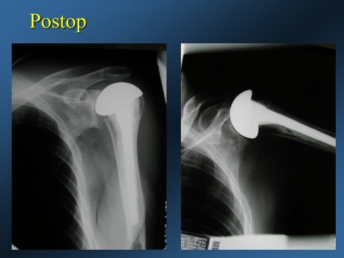 DePuy CTA Hemiarthroplasty versus Traditional Hemiarthroplasty