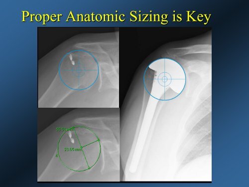 DePuy CTA Hemiarthroplasty versus Traditional Hemiarthroplasty