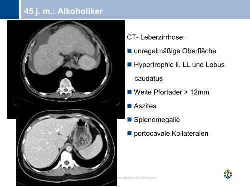 Computertomographie des Abdomens