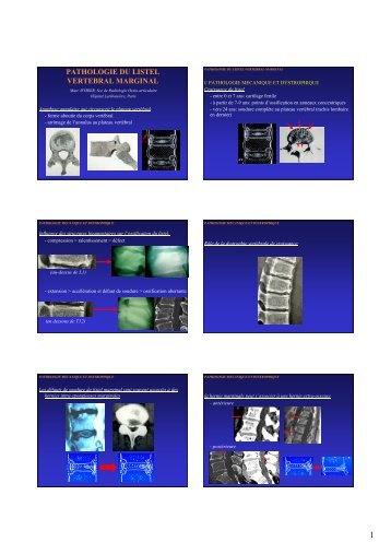 Pathologie du listel - Rhumatologie-bichat.com