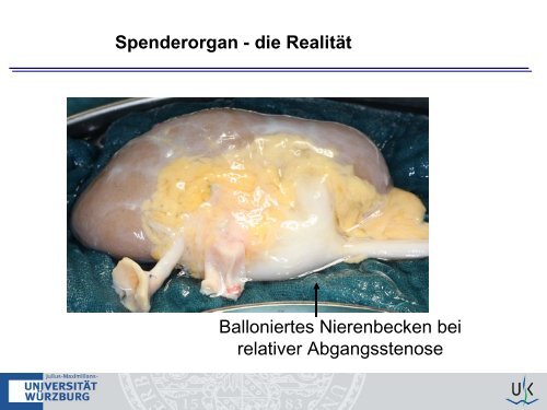 Nierenbeckenabgangsstenose der Tx-Niere - nieren-transplantation ...