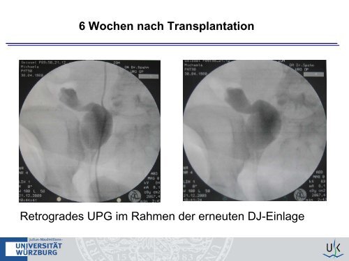 Nierenbeckenabgangsstenose der Tx-Niere - nieren-transplantation ...