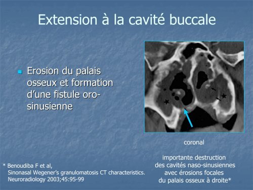 Imagerie TDM des atteintes ORL et pulmonaires dans la ...