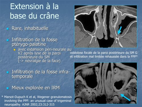 Imagerie TDM des atteintes ORL et pulmonaires dans la ...