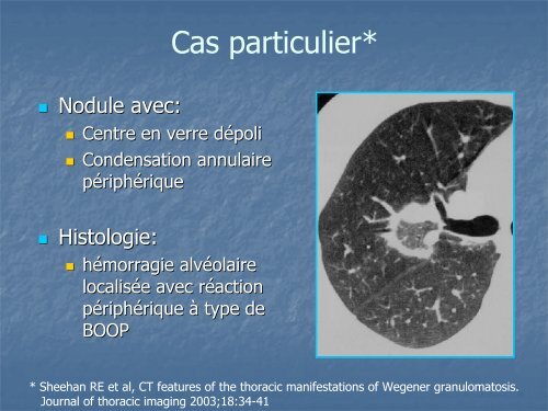 Imagerie TDM des atteintes ORL et pulmonaires dans la ...
