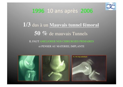 REPRISE DE LIGAMENTOPLASTIE DU GENOU