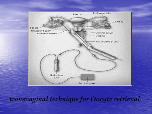 In vitro fertilisation supervised by Dr.Ali Alhussaini Dr. Sausan Talib