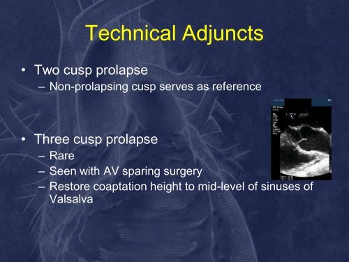 Assessment and Repair of Aortic Valve Cusp Prolapse: Implications ...