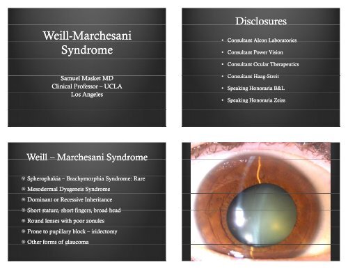 Weill-Marchesani Marchesani Syndrome