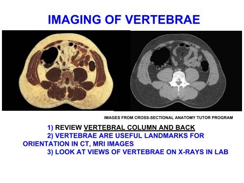 IMAGING OF VERTEBRAE