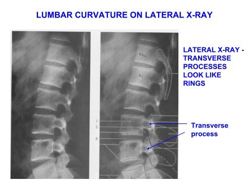 IMAGING OF VERTEBRAE