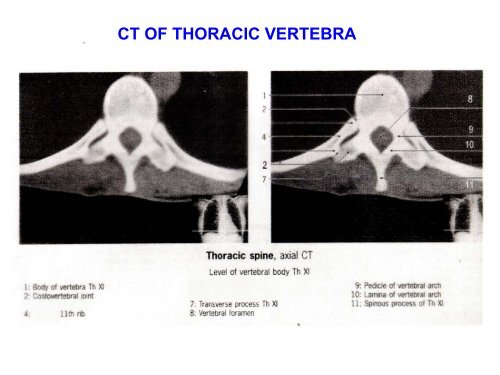 IMAGING OF VERTEBRAE