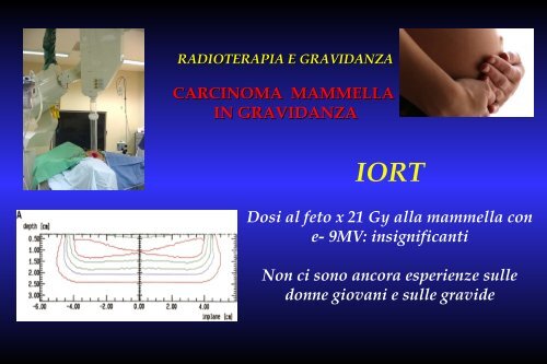 RADIOTERAPIA E GRAVIDANZA PROBLEMI DA AFFRONTARE