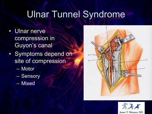 The Numb Hand (pdf)