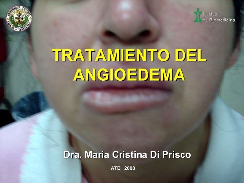 angioedema facial tratamiento
