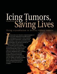 Icing Tumors, Saving Lives - Mallinckrodt Institute of Radiology