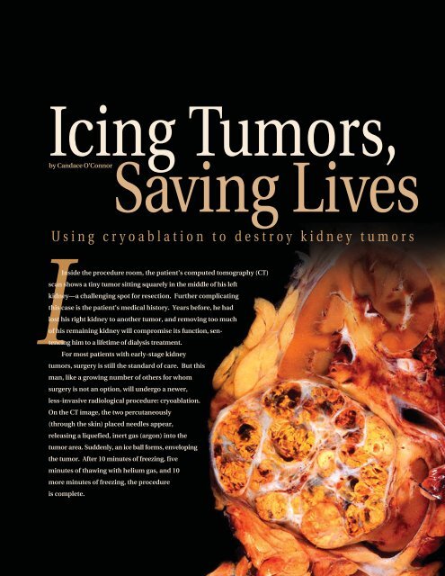 Icing Tumors Saving Lives Mallinckrodt Institute Of Radiology