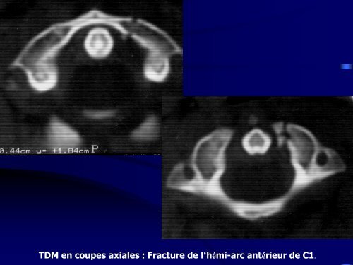 Les traumatismes du rachis de l'enfant