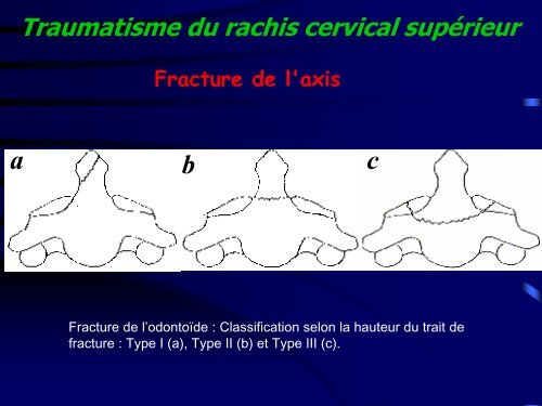 Les traumatismes du rachis de l'enfant