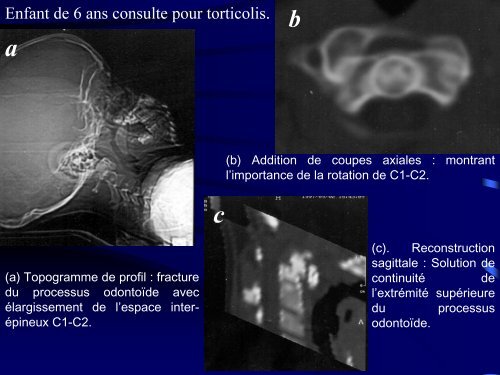 Les traumatismes du rachis de l'enfant