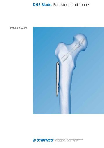 DHS Blade. For osteoporotic bone.