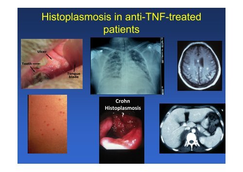 The changing epidemiology of invasive aspergillosis