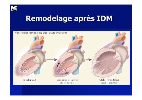 Physiopathologie de l'insuffisance cardiaque