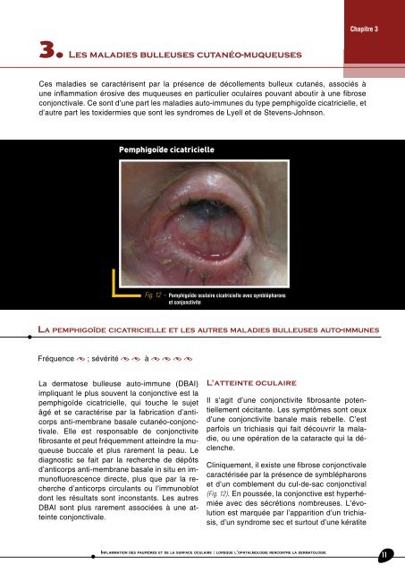 Inflammation des paupières et de la surface oculaire - Futurophta