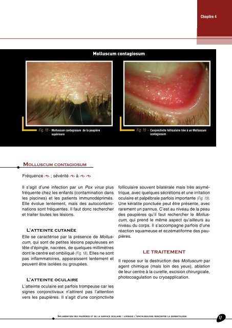 Inflammation des paupières et de la surface oculaire - Futurophta