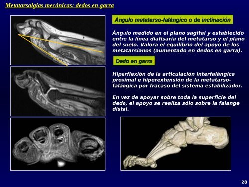 Metatarsalgias mecánicas: inestabilidad MTF