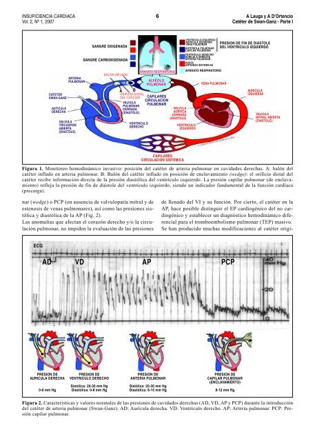 Monitoreo de las presiones de la arteria pulmonar CatÃ©ter de Swan ...