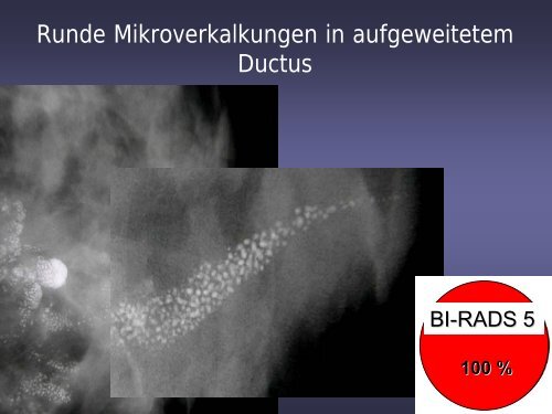 Neues Auftreten von Mikrokalk und Malignomrisiko