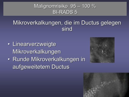 Neues Auftreten von Mikrokalk und Malignomrisiko