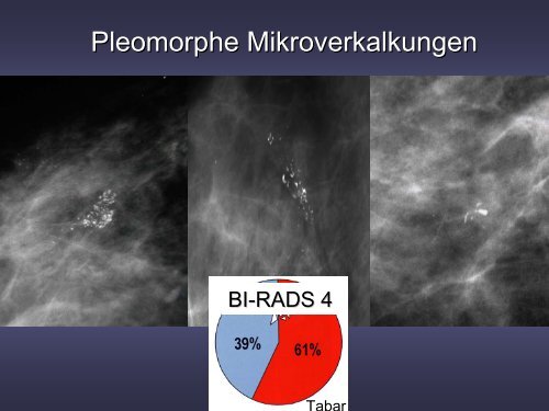 Neues Auftreten von Mikrokalk und Malignomrisiko