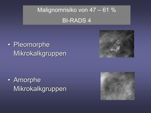 Neues Auftreten von Mikrokalk und Malignomrisiko