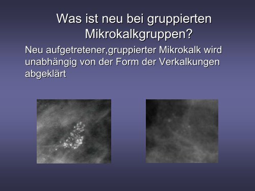 Neues Auftreten von Mikrokalk und Malignomrisiko