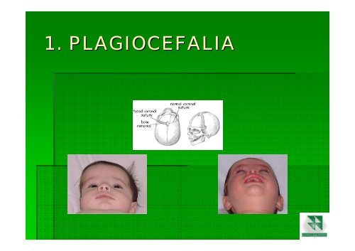 ALTERACIONES DEL DESARROLLO CRANEOFACIAL