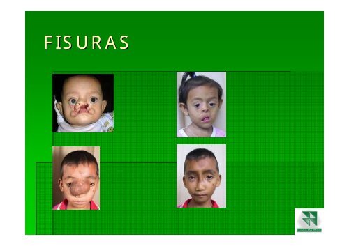 ALTERACIONES DEL DESARROLLO CRANEOFACIAL