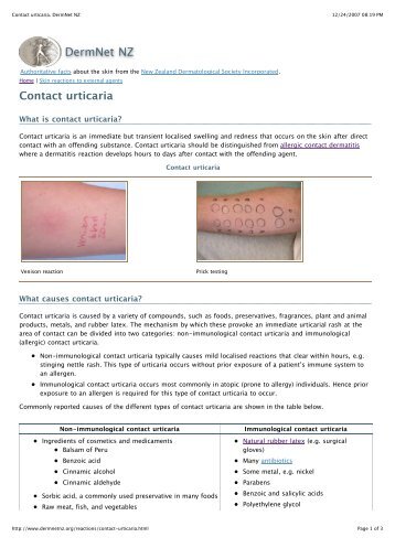 Contact urticaria. DermNet NZ - Dr-baumann-international.co.uk