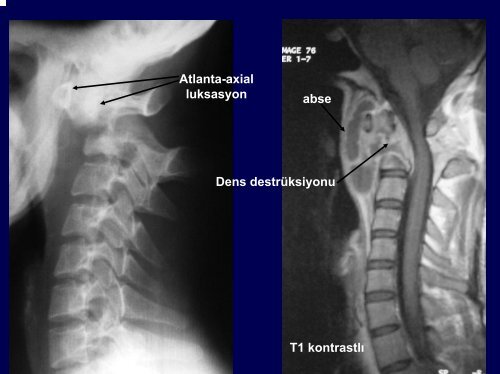 Diyafram ve gÃ¶ÄÃ¼s duvarÄ± lezyonlarÄ±