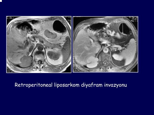 Diyafram ve gÃ¶ÄÃ¼s duvarÄ± lezyonlarÄ±