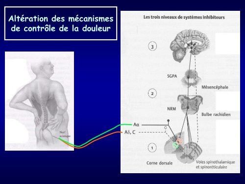 Douleur neuropathique