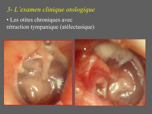 3- L'examen clinique otologique