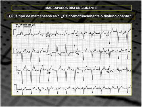 MARCAPASOS DISFUNCIONANTE. TIPOS DE ... - SEMM