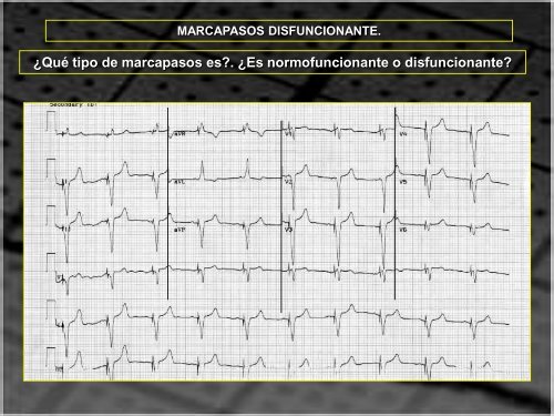 MARCAPASOS DISFUNCIONANTE. TIPOS DE ... - SEMM