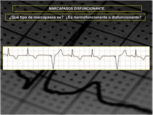 MARCAPASOS DISFUNCIONANTE. TIPOS DE ... - SEMM