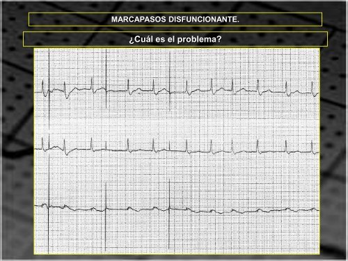 MARCAPASOS DISFUNCIONANTE. TIPOS DE ... - SEMM